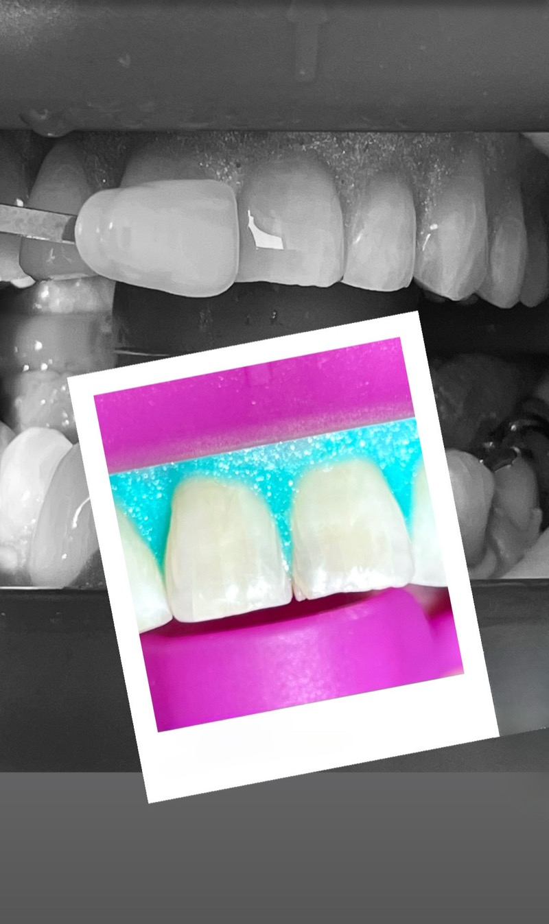 Sbiancamento dentale in-office con lampada professionale